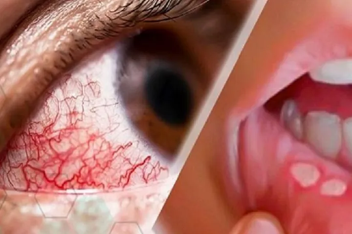 چرا اسم این بیماری “بهجت” است؟