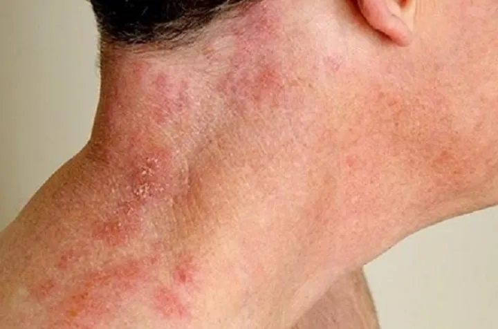 بالای پنجاه سال سن دارید؟ بیماری دردناک زونا در کمین است