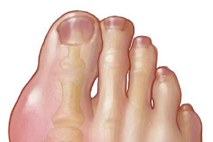 آنچه باید درباره نقرس بدانید