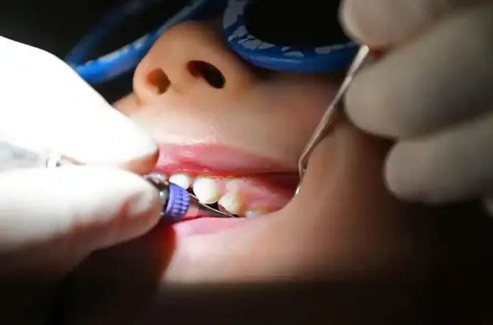 یک «اپیدمی خاموش»: پوسیدگی دندان در کودکان به علت مصرف بیش از حد قند